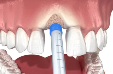 How Much Bone is Needed for a Dental Implant? Socket Preservation & Guided Bone Regeneration Explained